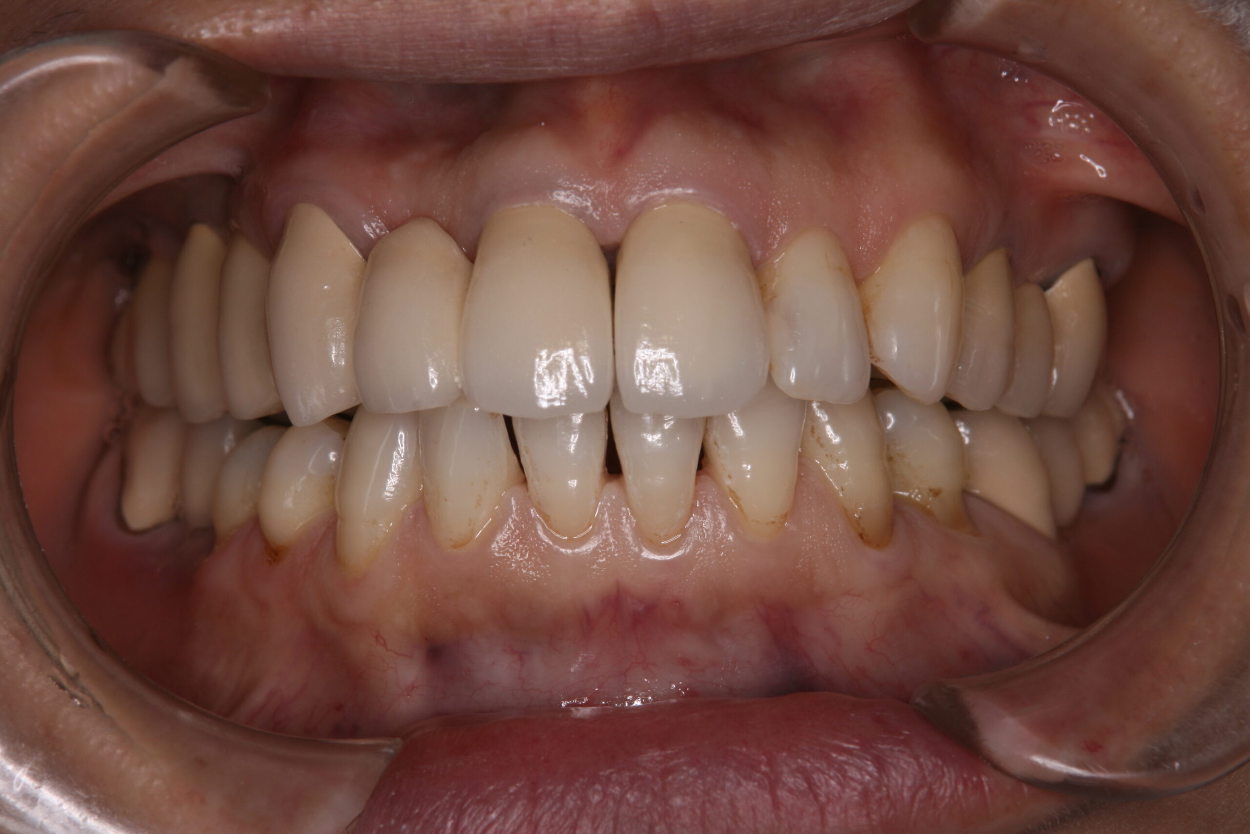 歯冠修復（審美歯科）症例33